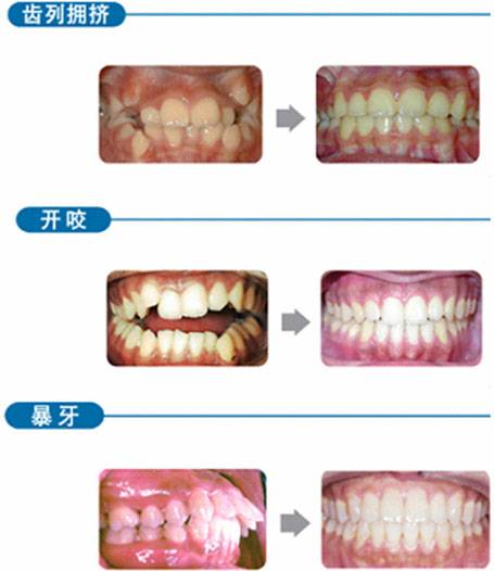 牙齿矫形