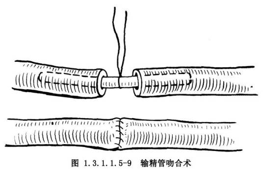 腹股沟斜疝修补术