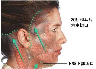 拉皮除皱