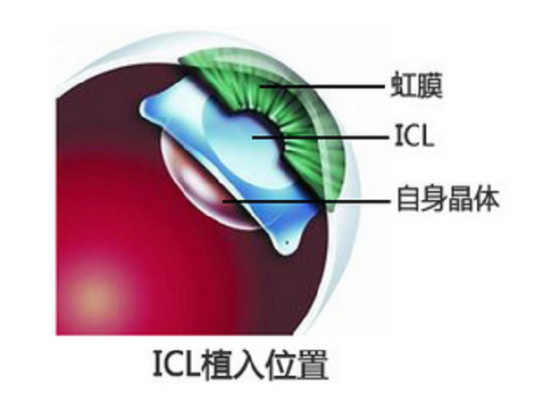 ICL人工晶体植入手术